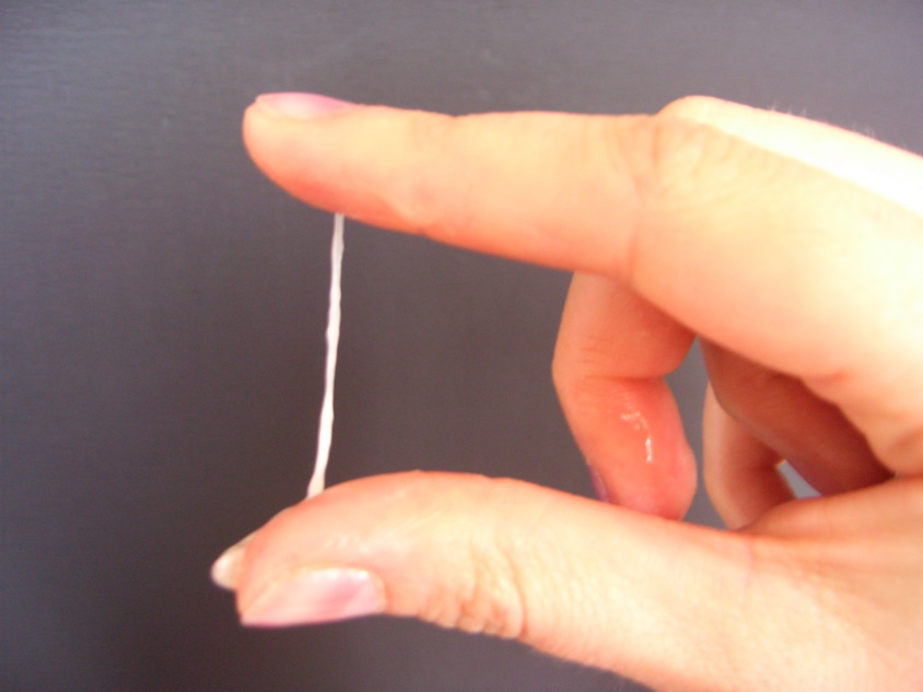 Bild oben: Zervixschleim ist zäh, elastisch, weißlich oder gelblich